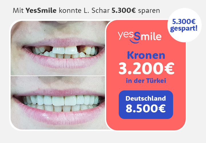 Vorher Nachher Zähne Kronen Kostenvergleich Deutschland Türkei