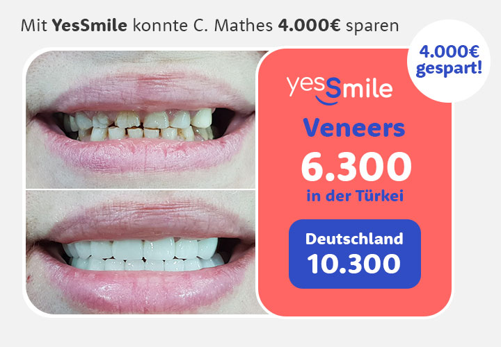 Vorher Nachher Zähne Veneers Kostenvergleich Deutschland Türkei
