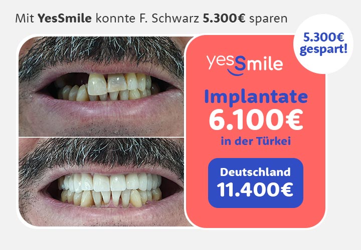 Vorher Nachher Zahnimplantat Kostenvergleich Deutschland Türkei