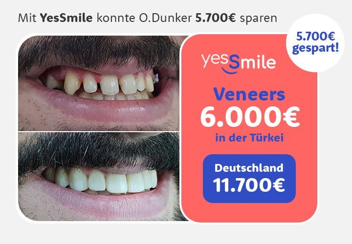 Vorher Nachher Zähne Veneers Kostenvergleich Deutschland Türkei