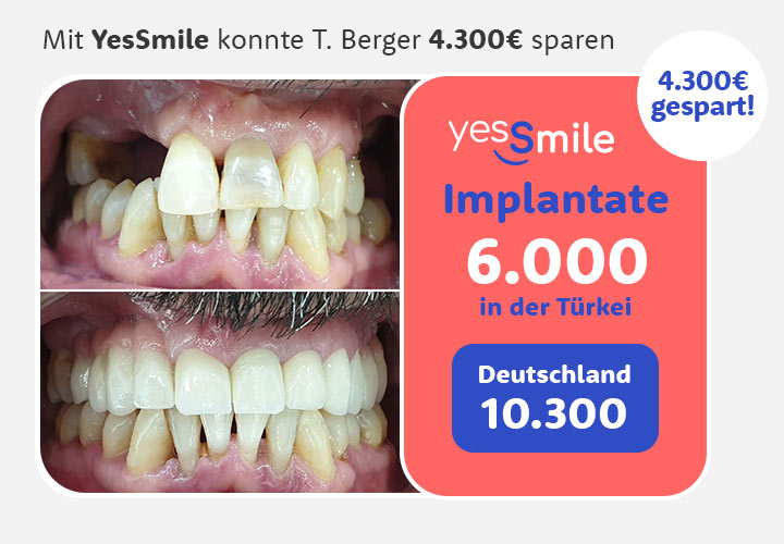 Vorher Nachher Zahnimplantat Kostenvergleich Deutschland Türkei