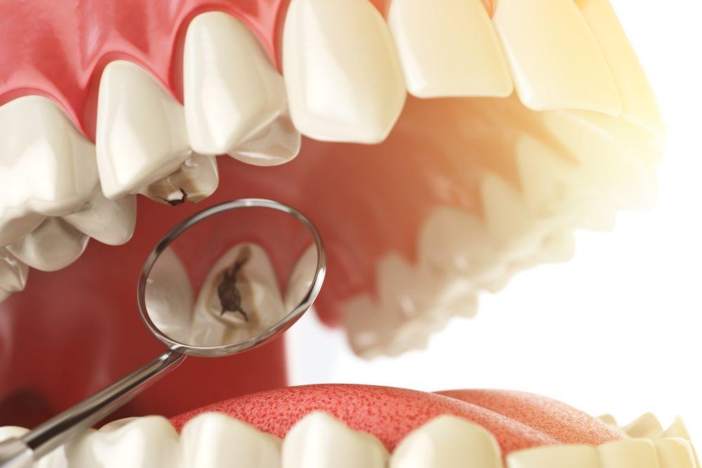 Warum fällt eine Zahnfüllung aus? Die Top 10 Fehler nach dem Füllen -  Proestetik