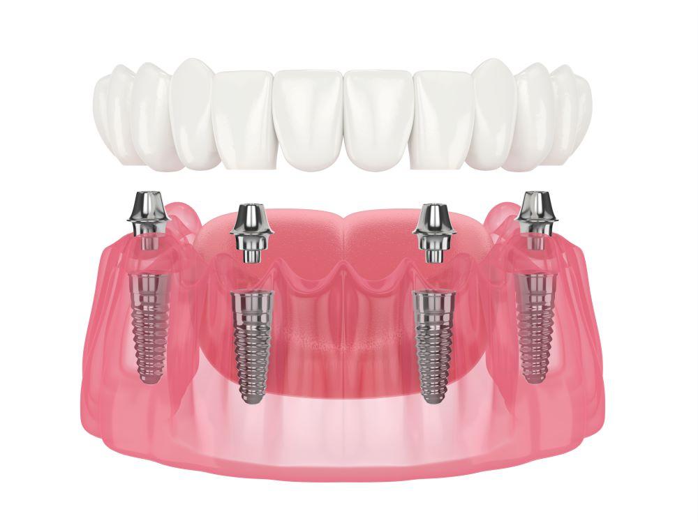 Vorteile Und Unterschiede All on 4 Gegen ber All on 6 Implantaten vorteile-und-unterschiede-all-on-4-gegen-ber-all-on-6-implantaten