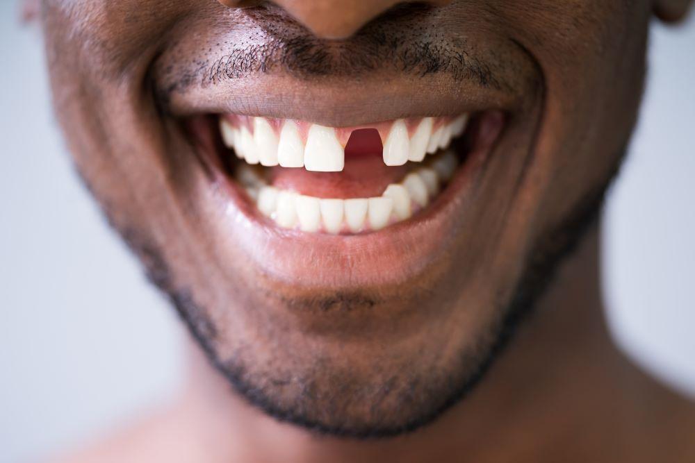 Ursachen für Zahnverlust