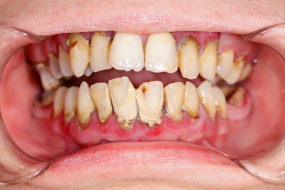 schlechte Zähne