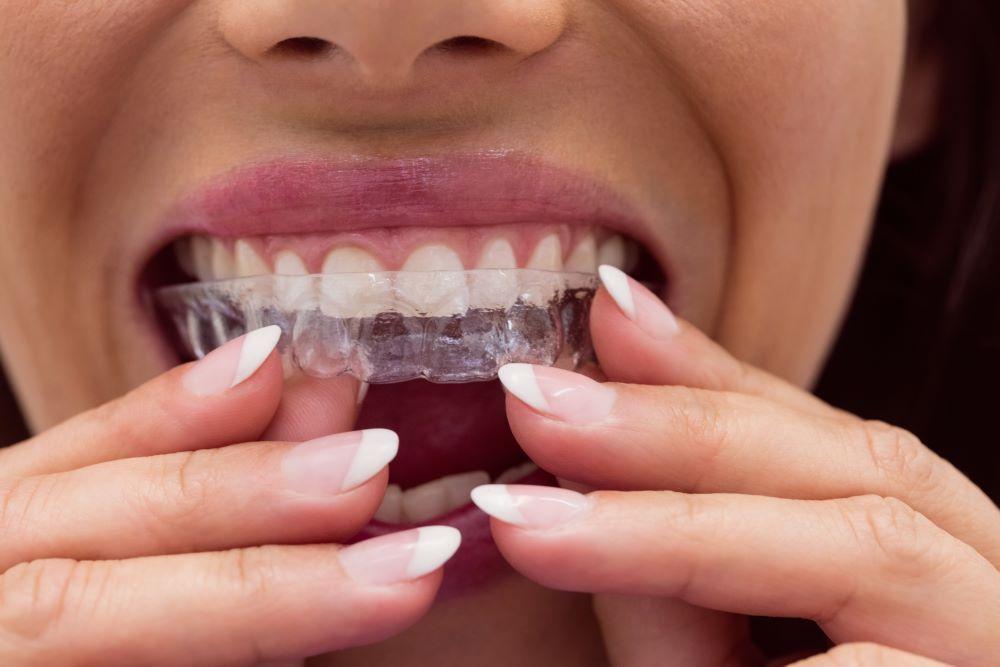 Zahnfehlstellung bei Erwachsenen