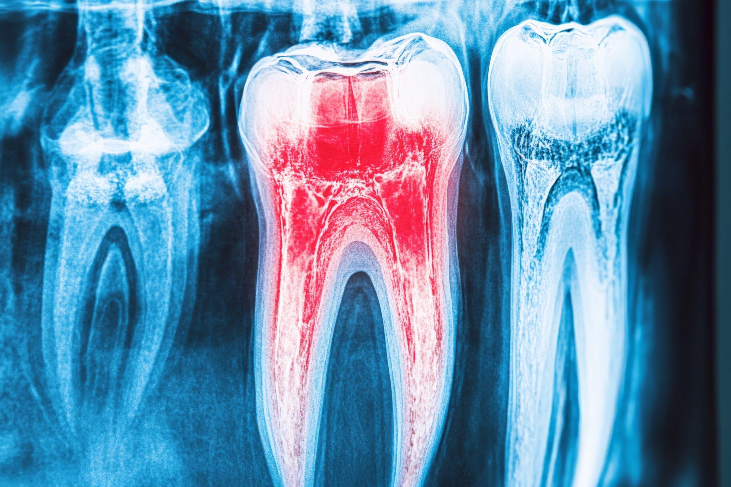 Pulpitis