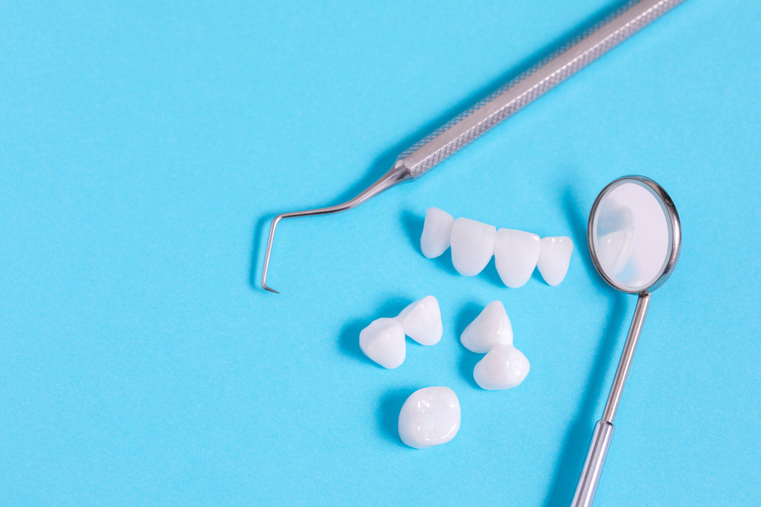 Veneers ab welchem Alter