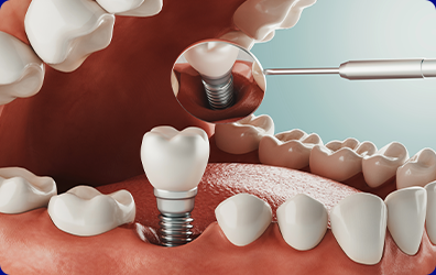 Einsetzen des Implantats