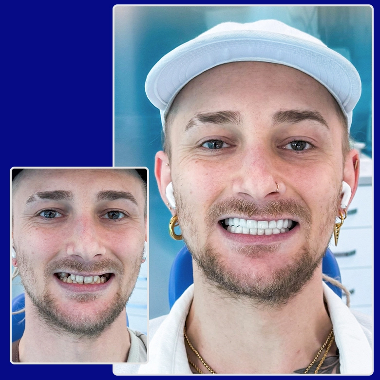 Yessmile-Patient Aaron im Vorher-nachher-Vergleich nach einer Zahnimplantat-Behandlung: links mit abgenutzten und lückenhaften Zähnen, rechts mit perfekten, weißen Implantaten und einem modernen Lächeln.