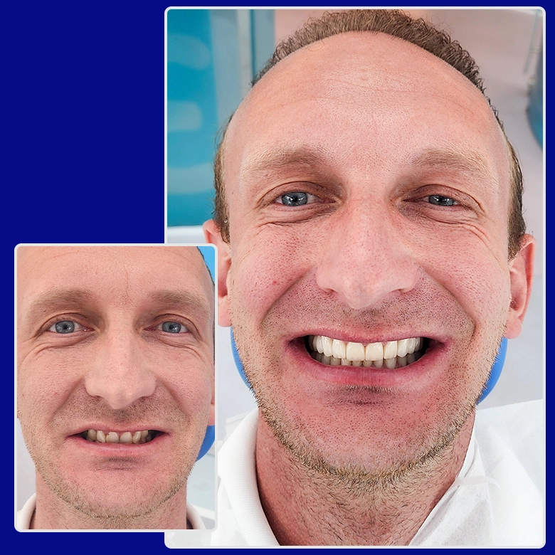 Yessmile-Patient Lukas vor und nach einer Zahnimplantat-Behandlung: links mit Zahnlücken und unregelmäßigen Zähnen, rechts mit einem vollständigen, ästhetischen Lächeln.
