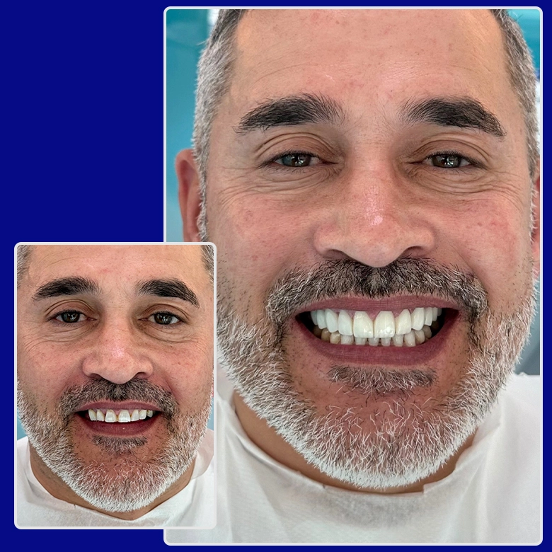 Vorher-nachher-Foto von Yessmile-Patient Maurizio mit grauem Bart nach einer Zahnimplantat-Behandlung: links mit unregelmäßigen, verfärbten Zähnen, rechts mit vollständigem, weißem Zahnersatz und einem neuen Lächeln.