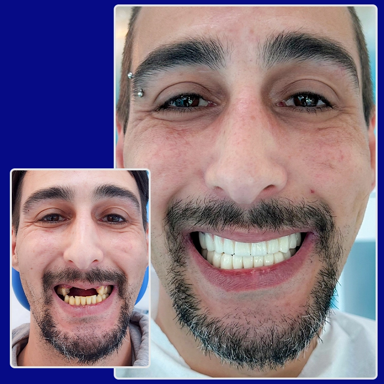 Vorher-nachher-Bild von Yessmile-Patient Serkan: mit stark beschädigten und fehlenden Zähnen vor der Behandlung und einem vollständigen, weißen Lächeln nach der Zahnimplantat-Behandlung.