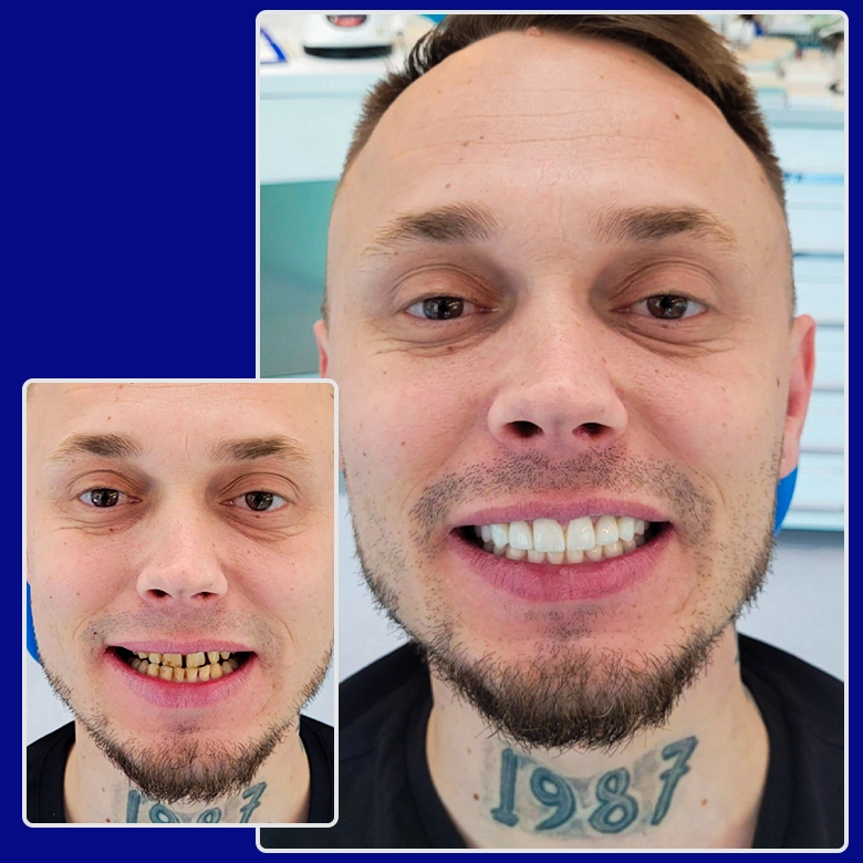 Yessmile-Patient Andrej mit sichtbaren Zahnverfärbungen vor der Behandlung und strahlend weißen Zähnen nach dem Einsetzen von Zahnkronen – ein Vorher-nachher-Vergleich.