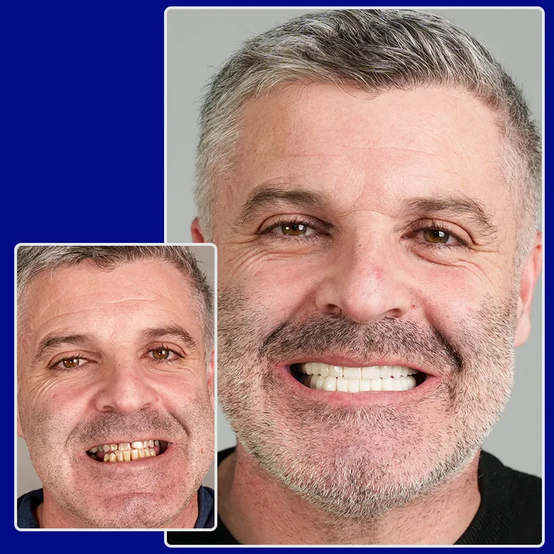 Vorher-nachher-Foto von Yessmile-Patient Calogero nach einer Zahnkronen-Behandlung: links mit stark verfärbten, abgenutzten Zähnen, rechts mit gleichmäßigen, weißen Zahnkronen und einem selbstbewussten Lächeln.
