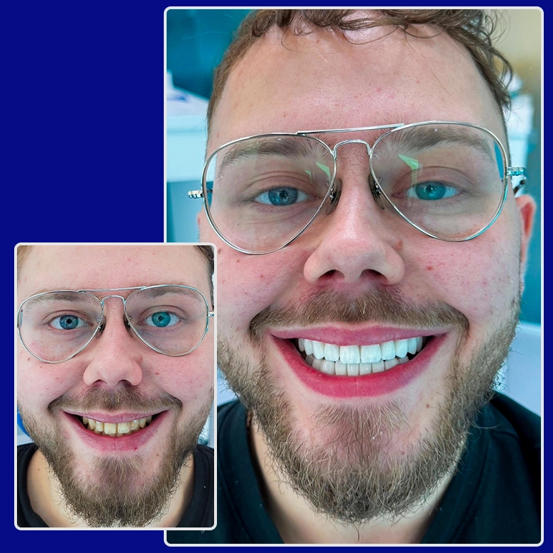 Vorher-nachher-Bild von Yessmile-Patient Can nach einer Zahnkronen-Behandlung: links mit verfärbten Zähnen, rechts mit einem strahlenden, weißen Lächeln.