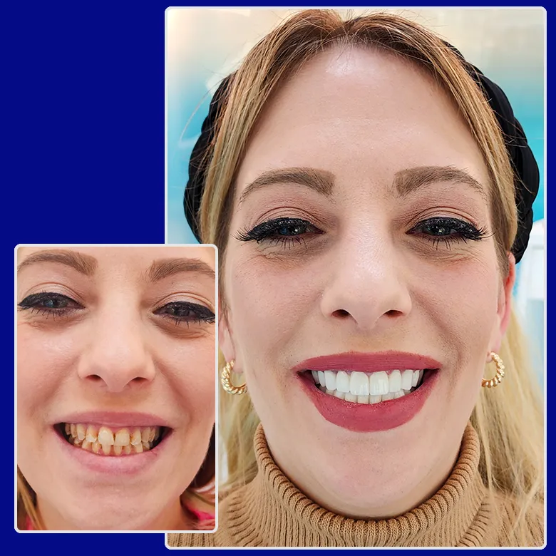 Vorher-nachher-Foto von Yessmile-Patientin Carina nach einer Zahnkronen-Behandlung: links mit stark verfärbten und beschädigten Zähnen, rechts mit einem strahlend weißen, ästhetischen Lächeln.