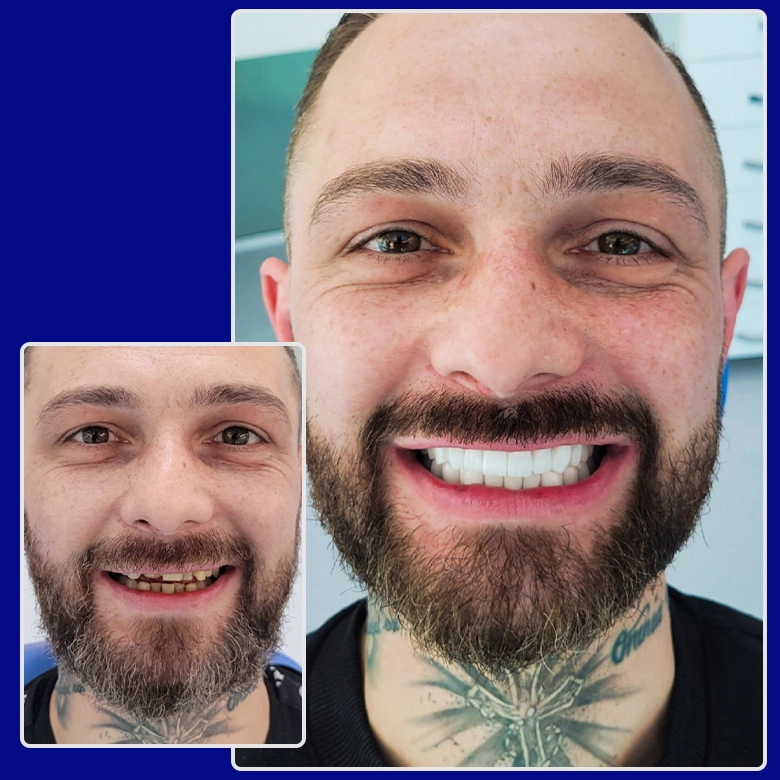 Vorher-nachher-Foto von Yessmile-Patient Dennis mit sichtbarem Zahnersatz: links mit beschädigten und verfärbten Zähnen, rechts mit makellosen, weißen Zahnkronen.