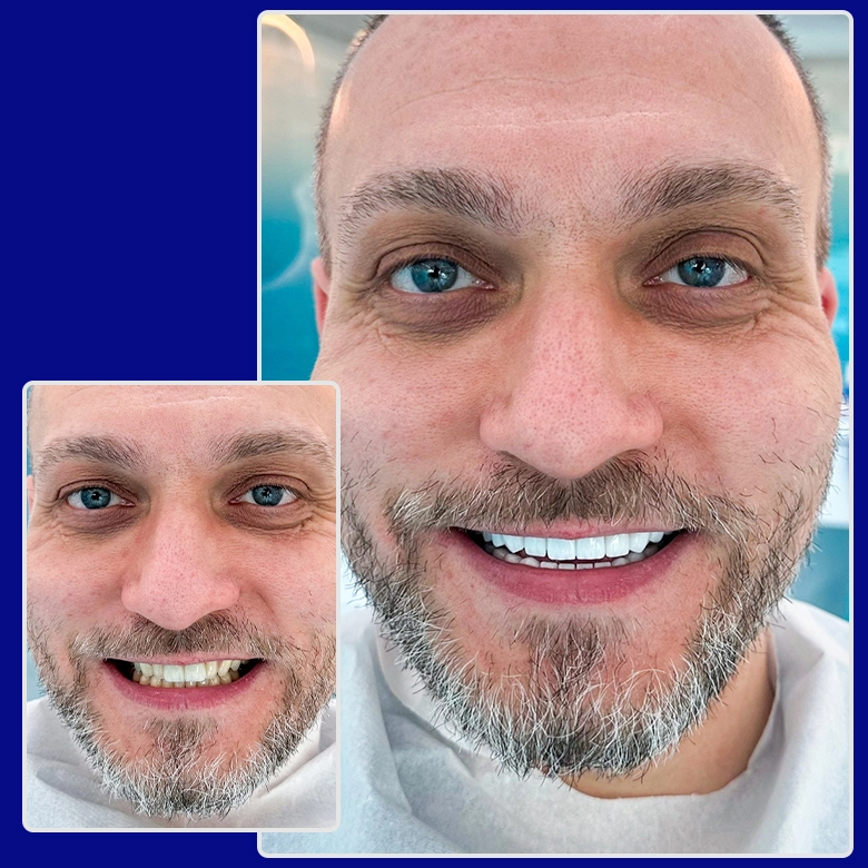 Vorher-nachher-Foto von Yessmile-Patient Georg nach einer Zahnkronen-Behandlung: links mit verfärbten und abgenutzten Zähnen, rechts mit einem ebenmäßigen, weißen Lächeln.
