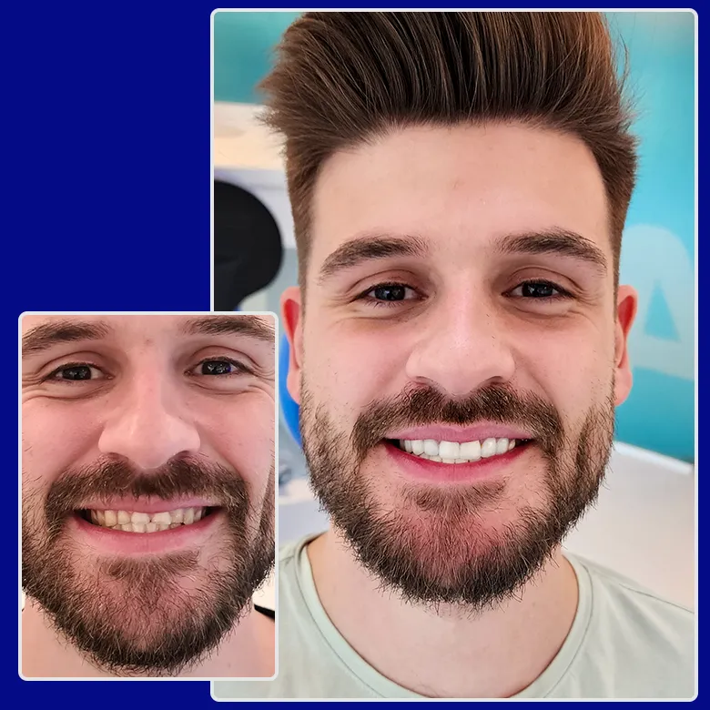 Vorher-nachher-Foto von Yessmile-Patient Jan nach einer Zahnkronen-Behandlung: links mit unregelmäßigen und verfärbten Zähnen, rechts mit geraden, weißen Kronen und einem strahlenden Lächeln.