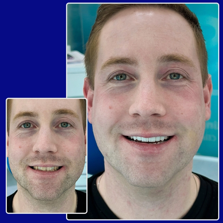 Vorher-nachher-Bild von Yessmile-Patient Jonathan vor und nach einer Zahnkronen-Behandlung: links mit verfärbten und abgenutzten Zähnen, rechts mit einem gleichmäßigen, weißen Lächeln.