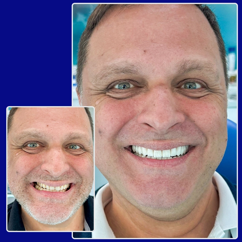 Vorher-nachher-Foto von Yessmile-Patient Lars nach einer Zahnkronen-Behandlung: links mit stark abgenutzten und unregelmäßigen Zähnen, rechts mit gleichmäßigen, strahlend weißen Kronen und einem neuen Lächeln.