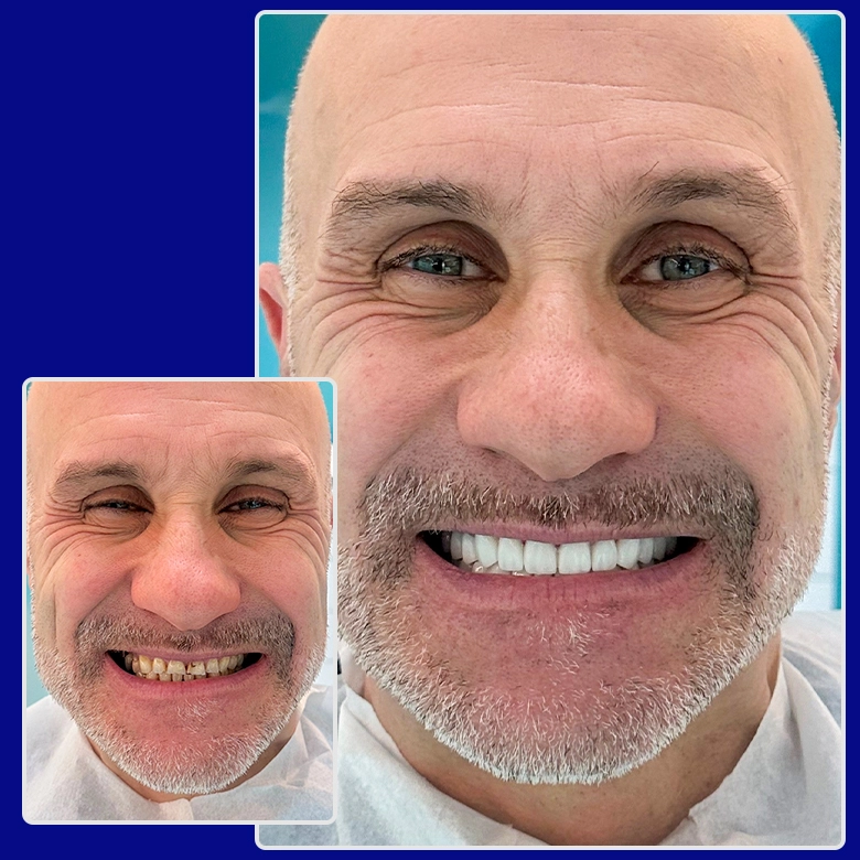 Vorher-nachher-Foto von Yessmile-Patient Luigi nach einer Zahnkronen-Behandlung: links mit stark verfärbten und abgenutzten Zähnen, rechts mit weißen, ebenmäßigen Zahnkronen und einem neuen Lächeln.
