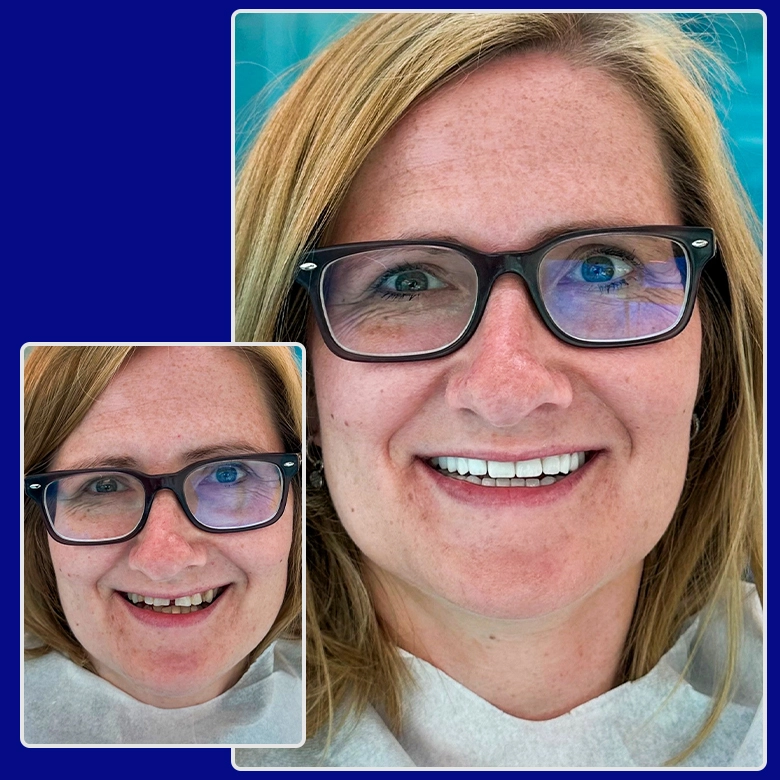 Vorher-nachher-Foto von Yessmile-Patientin Meike nach einer Zahnkronen-Behandlung: links mit Zahnlücken und Verfärbungen, rechts mit einem geraden, weißen und ästhetischen Lächeln.