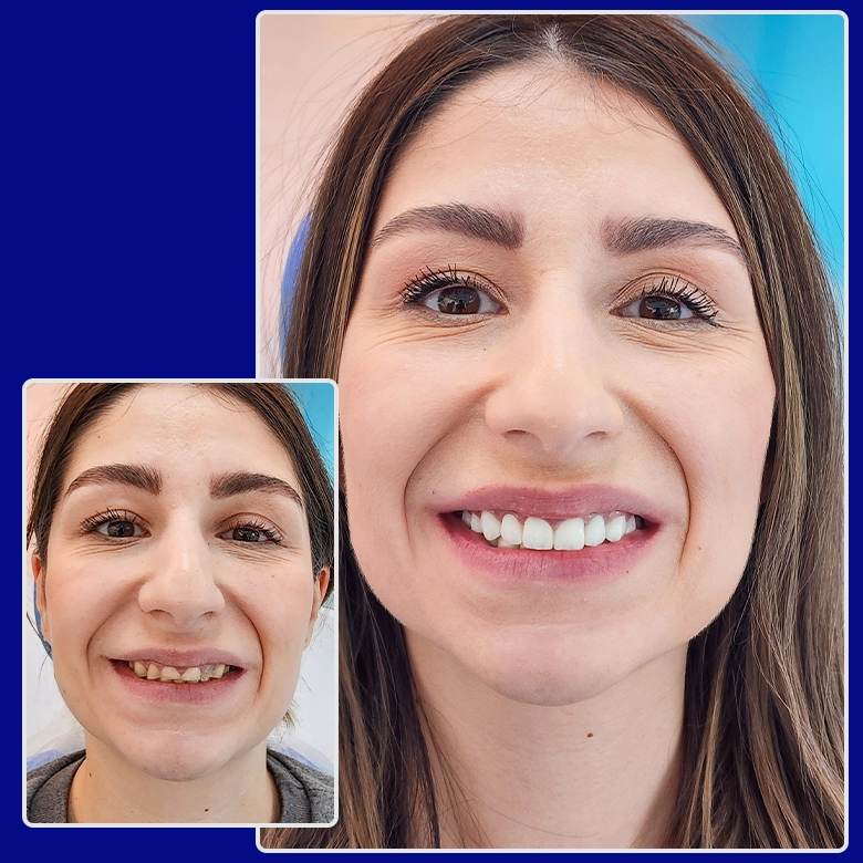 Vorher-nachher-Foto von Yessmile-Patientin Panagiota nach einer Zahnkronen-Behandlung: links mit beschädigten und schiefen Zähnen, rechts mit einem symmetrischen, weißen Lächeln.