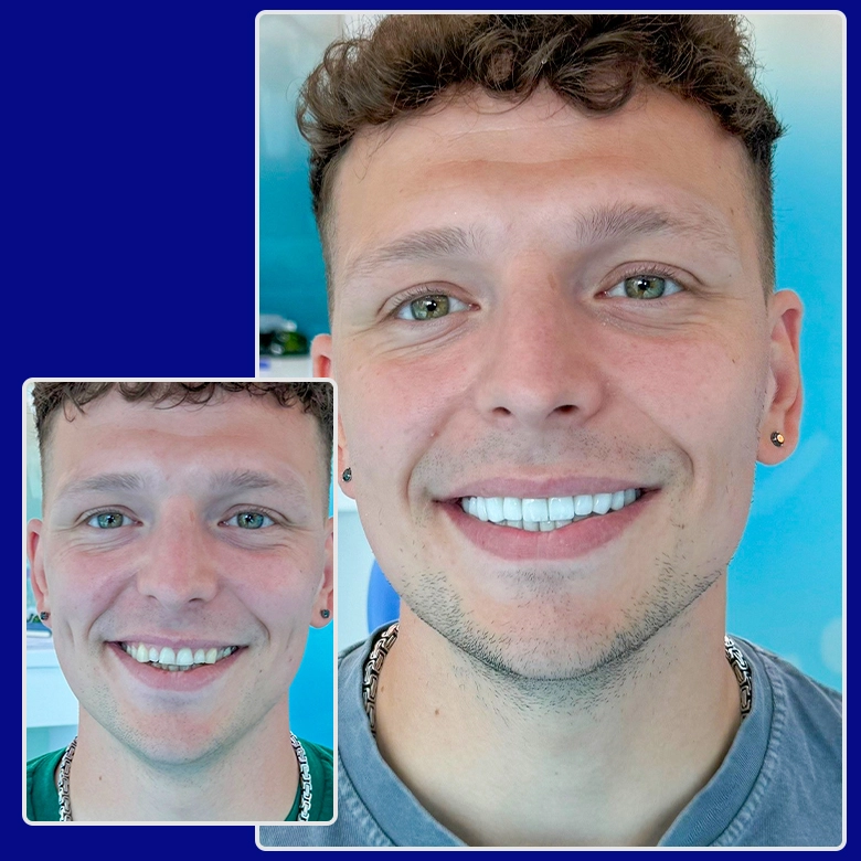 Vorher-nachher-Foto von Yessmile-Patient Philipp nach einer Zahnkronen-Behandlung: links mit leicht unregelmäßigen Zähnen, rechts mit einem makellosen, weißen Lächeln.