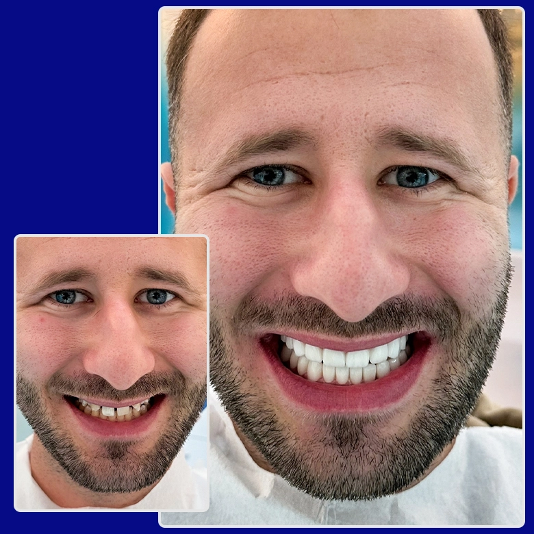 Vorher-nachher-Vergleich von Yessmile-Patient Till: mit Zahnlücken und verfärbten Zähnen vor der Behandlung sowie einem perfekten, weißen Lächeln nach dem Einsetzen von Zahnkronen.