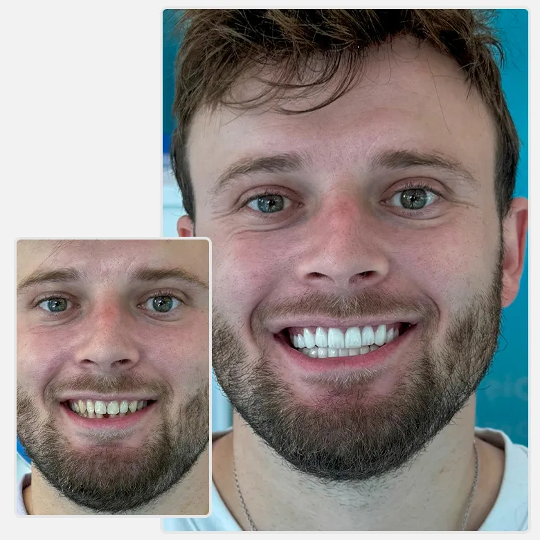 YesSmile Patient Danilo zeigt seine Veneers