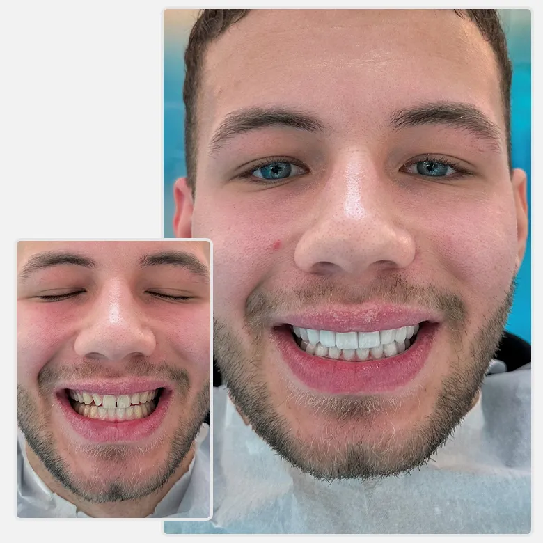 Vorher-nachher-Bild von Yessmile-Patient Moritz nach einer Veneers-Behandlung: links mit verfärbten und unregelmäßigen Zähnen, rechts mit einem geraden, weißen Lächeln.