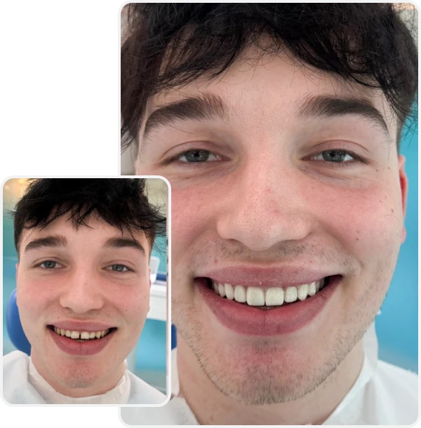 Vorher Nachher Vergleich für Veneers bei YesSmile Patient Timon