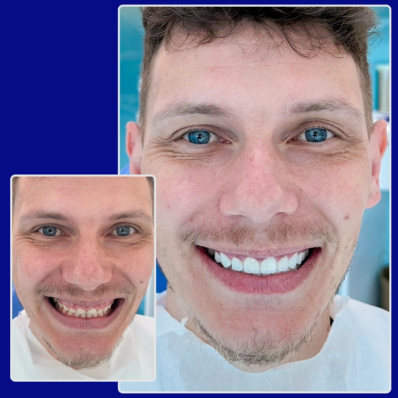Vorher-nachher-Foto von Yessmile-Patient Fabian nach einer Zahnkronen-Behandlung: links mit stark abgenutzten und verfärbten Zähnen, rechts mit einem strahlenden, weißen Lächeln.