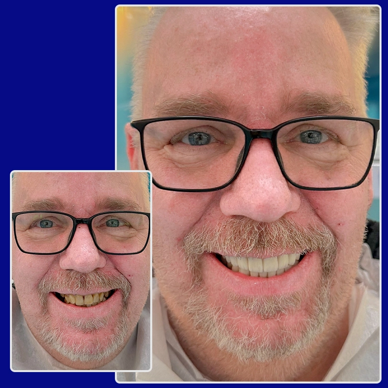 Vorher-Nachher-Foto von Yessmile patient Thomas nach Zahnkronen-Behandlung: links mit stark verfärbten und abgenutzten Zähnen, rechts mit natürlich wirkenden, weißen Zahnkronen und neuem Lächeln.