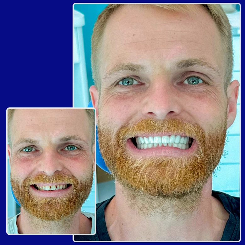 Vorher-nachher-Bild von Yessmile-Patient Tim nach einer Zahnkronen-Behandlung: links mit abgenutzten und unregelmäßigen Zähnen, rechts mit gleichmäßigen, weißen Kronen und einem strahlenden Lächeln.