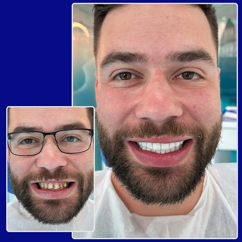 Vorher Nachher Vergleich Kronen YesSmile Patient Fabian