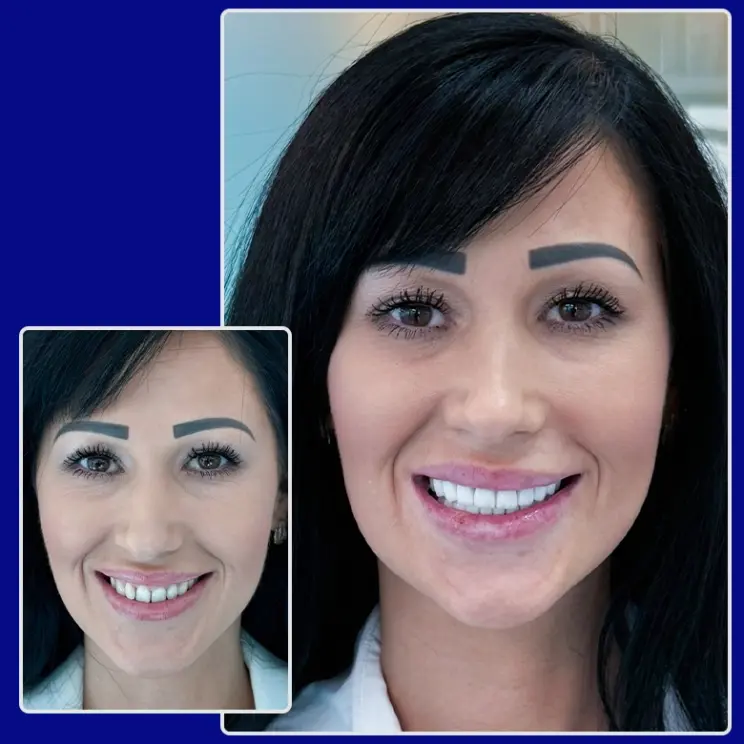 Vorher Nachher Vergleich Kronen von YesSmile Patientin Sofia