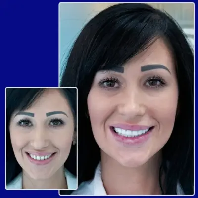 Vorher Nachher Vergleich Kronen von YesSmile Patientin Sofia