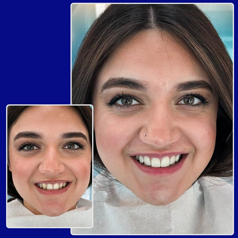 Yessmile-Patientin Anita vor und nach einer Veneers-Behandlung: links mit unregelmäßigen Frontzähnen, rechts mit einem gleichmäßigen, strahlend weißen Lächeln.