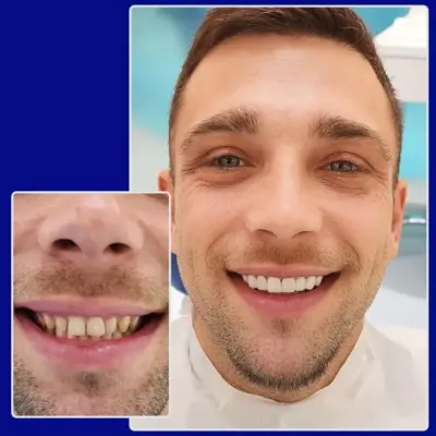 Vorher-nachher-Foto von Yessmile-Patient Cornel nach einer Zahnbehandlung mit Zahnkronen: links mit verfärbten und unregelmäßigen Zähnen, rechts mit einem makellosen, weißen Lächeln.