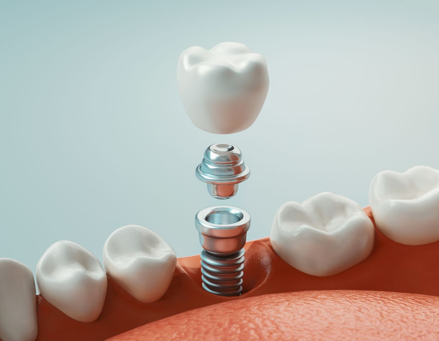 Implantatfreilegung