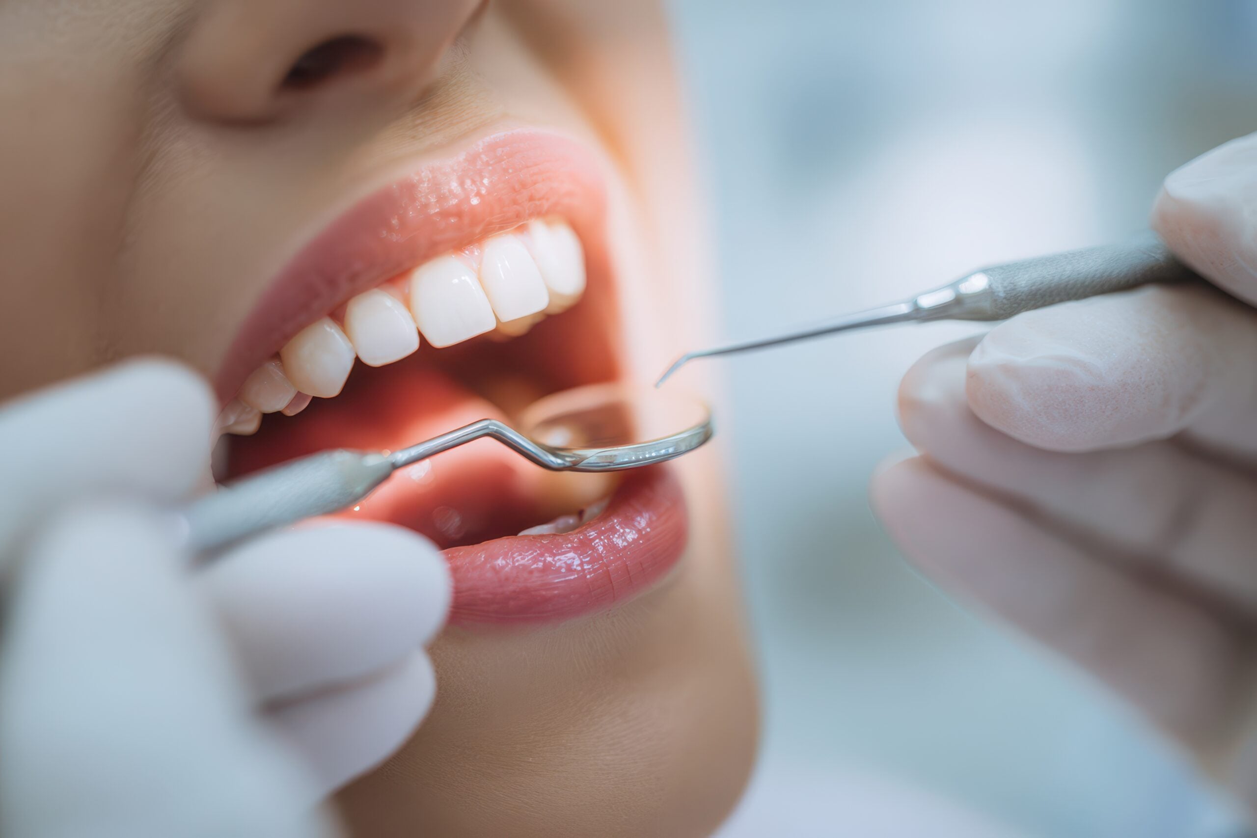 Demineralisierung der Zähne