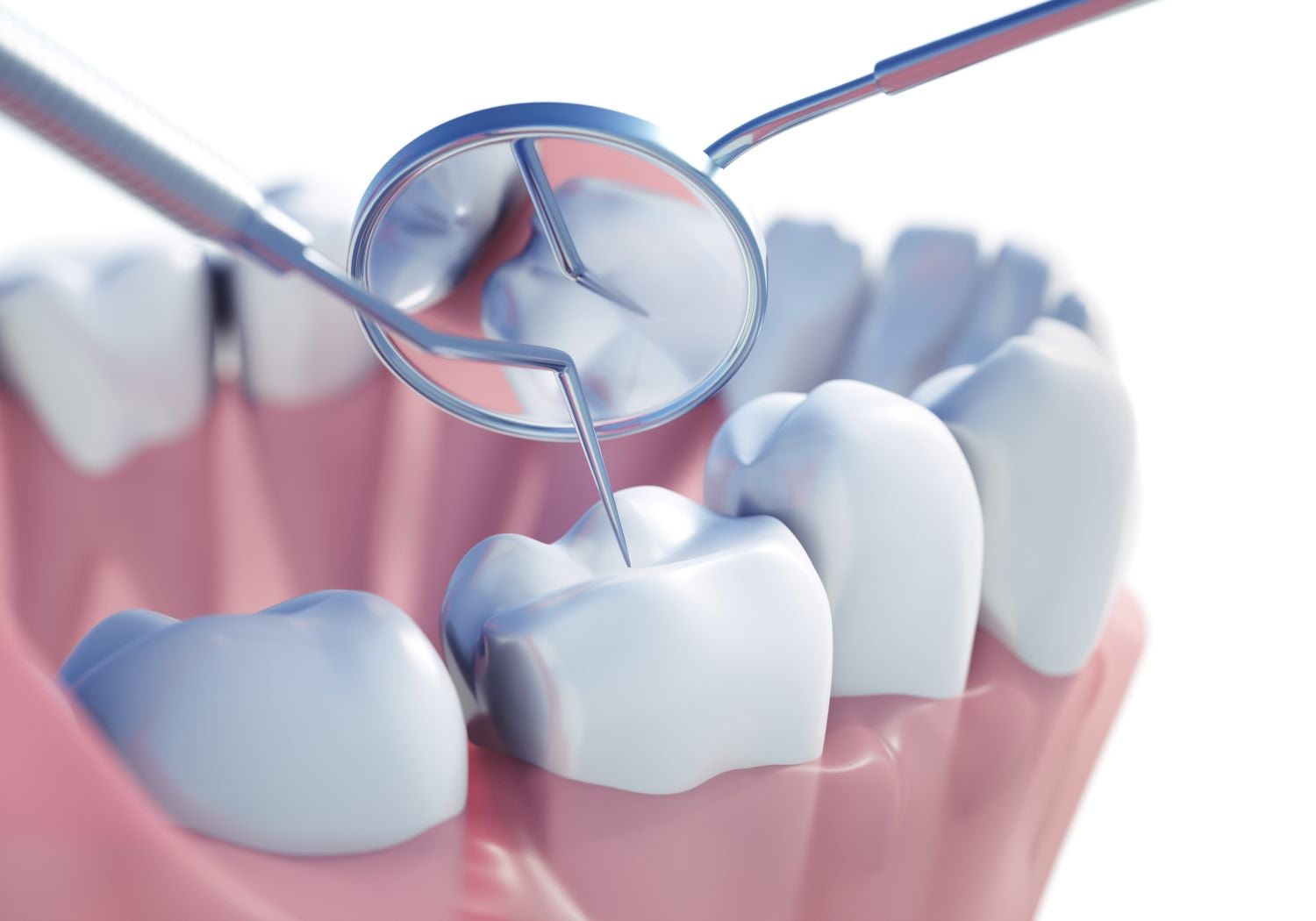 Fissurenversiegelung