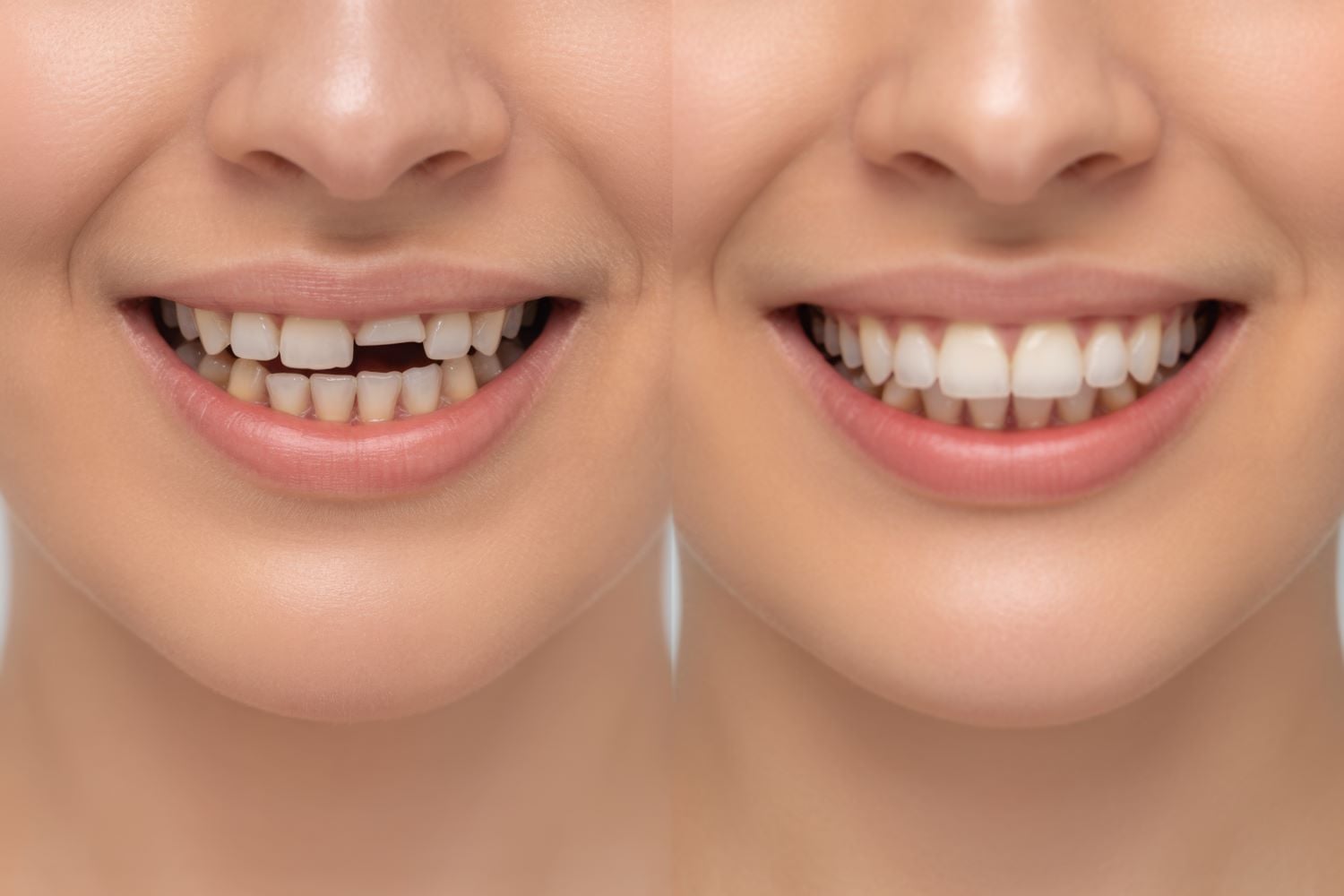 Schneidezahn abgebrochen