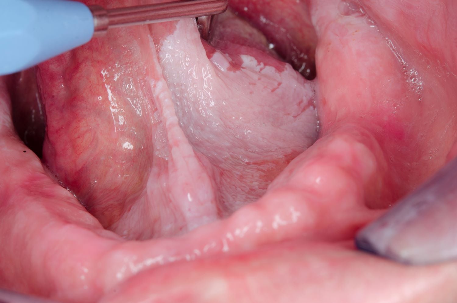 Leukoplakie