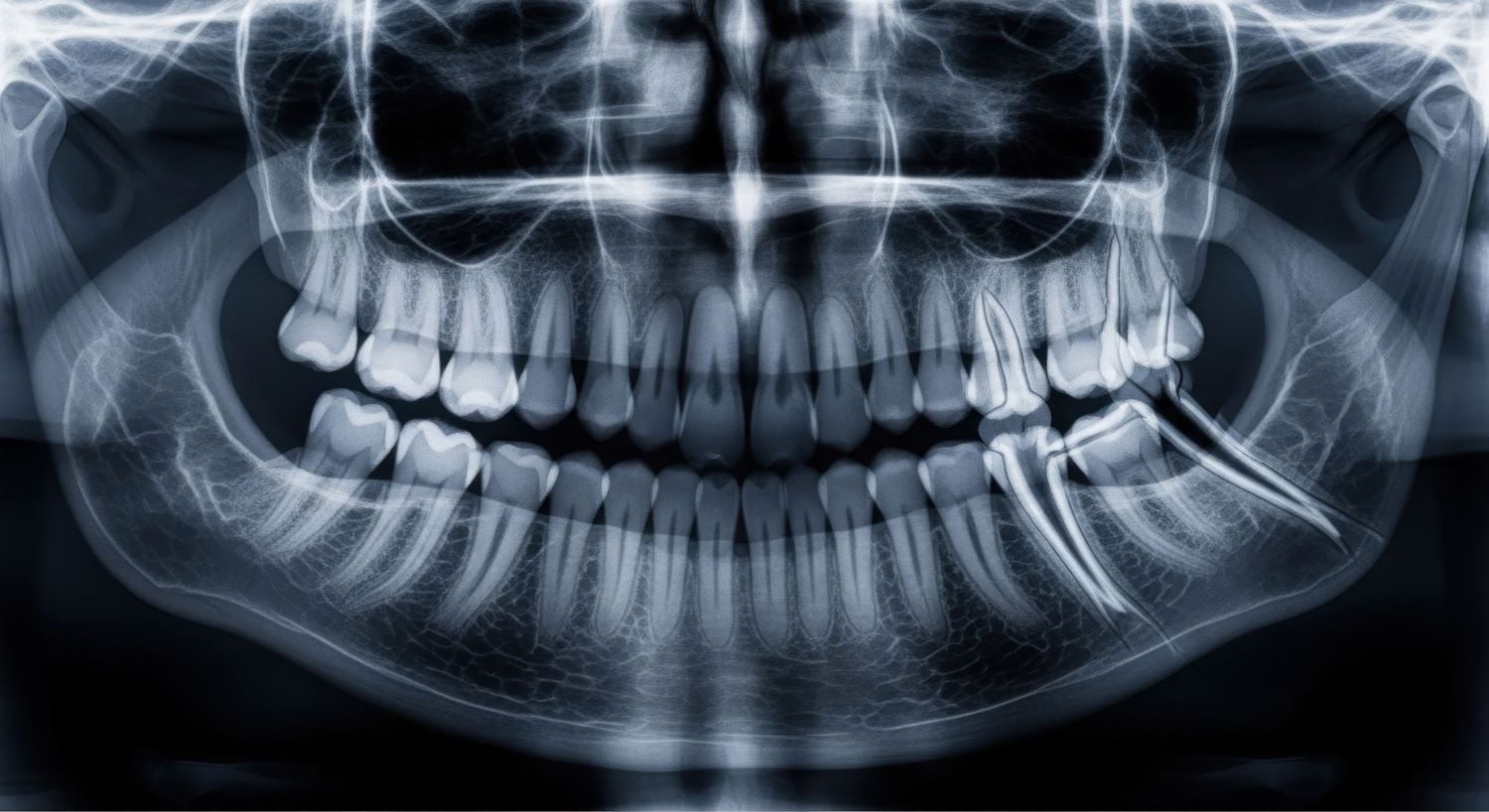 Wurzelresorption
